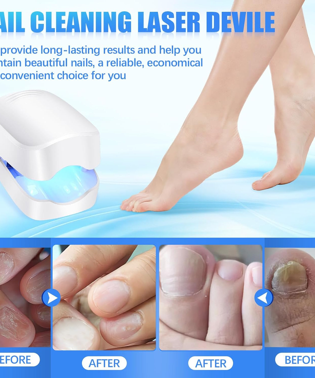 Rechargeable Nail Fungus Laser – Anti-Fungal Device for Toenails, Hands & Feet (Home Use)